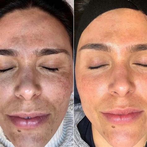 tca peel reviews|TCA Peels: What To Know and How They Work .